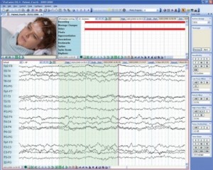 Lee más sobre el artículo Profusión EEG