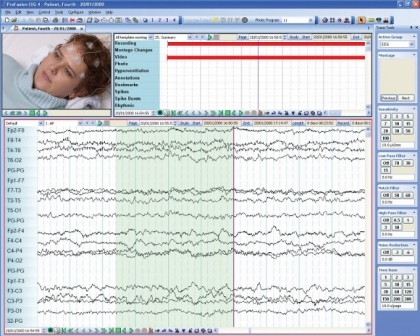 En este momento estás viendo Profusión EEG